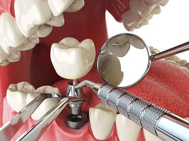 Best Emergency Wisdom Teeth Removal in Great Falls, VA